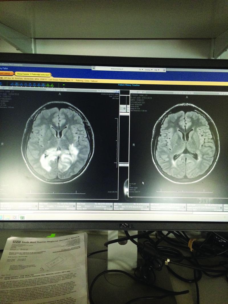 Liam's brain scans